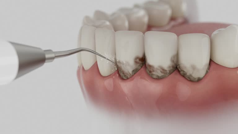 Reliable Dental Implants contractor in Avon, CO by Smile Center Dentistry